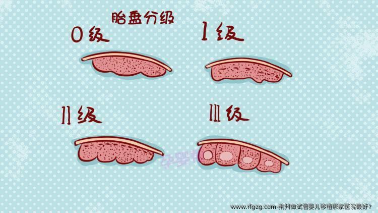 荆州做代孕移植哪家医院较好？